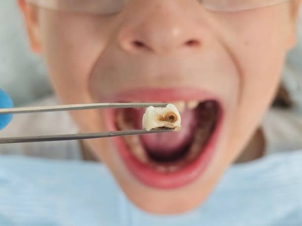 Dentist for Dental Trauma in AL